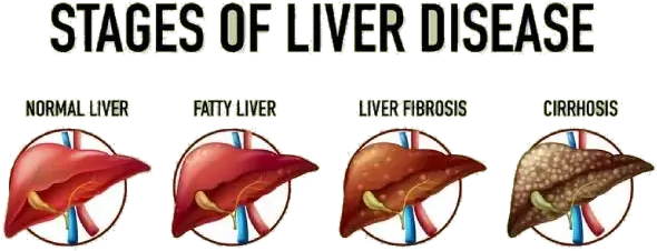 Liver Cirrhosis Treatment